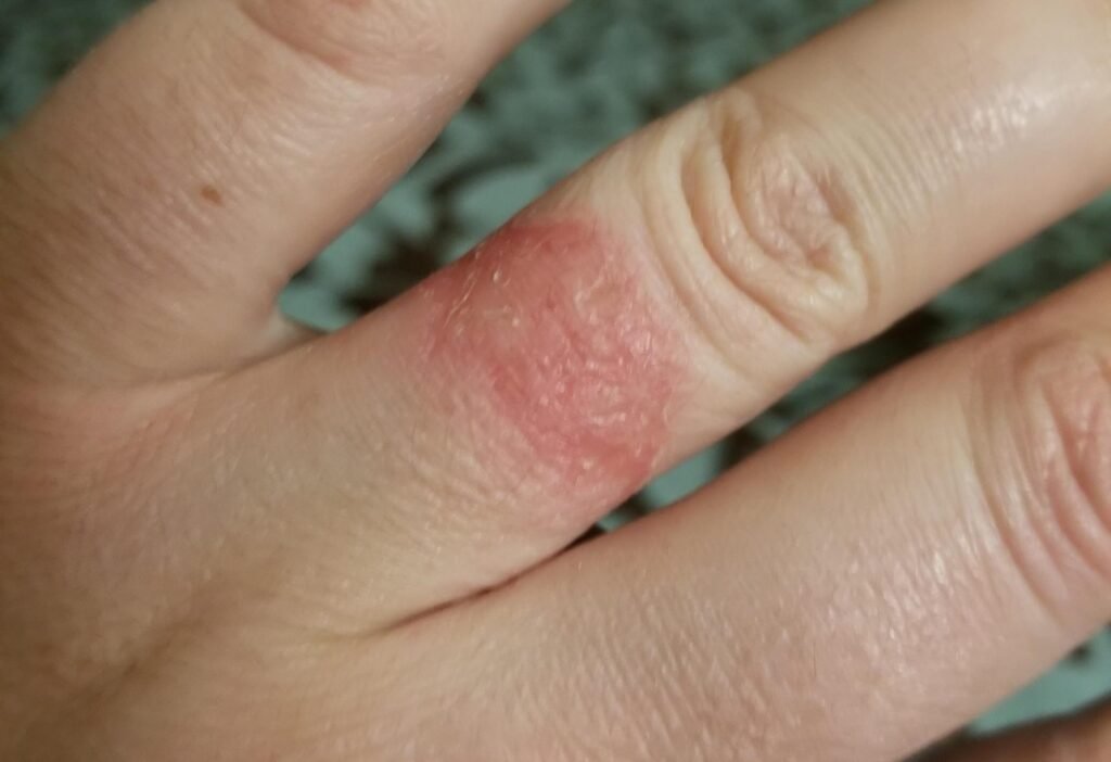 Ring rash